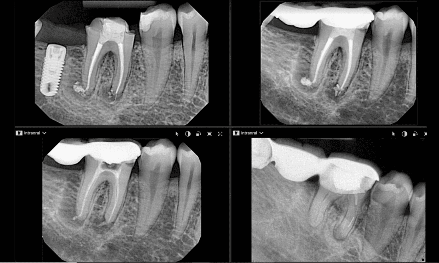 J Shaped Lesions And Cracked Teeth Hopkinton Endodontics Judy